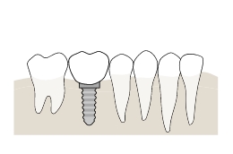 インプラント治療