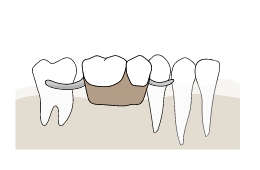 入れ歯治療