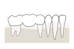 ブリッジ治療